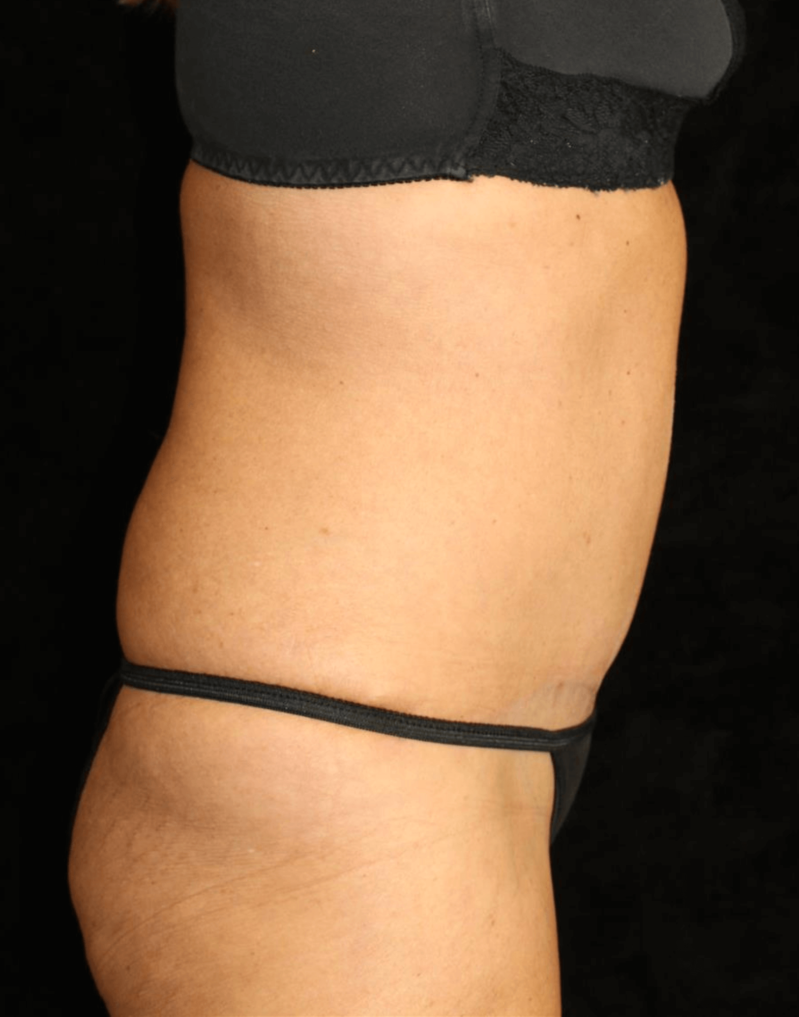Liposuction Patient Photo - Case 15392 - after view-2