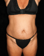 Liposuction before and after results - Nashville patient - Before