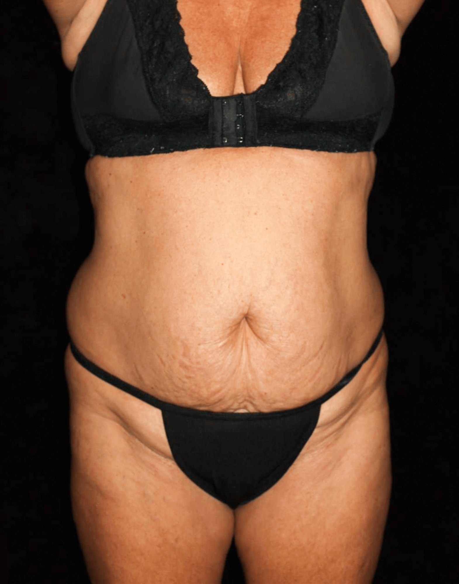 Liposuction Patient Photo - Case 15392 - before view-