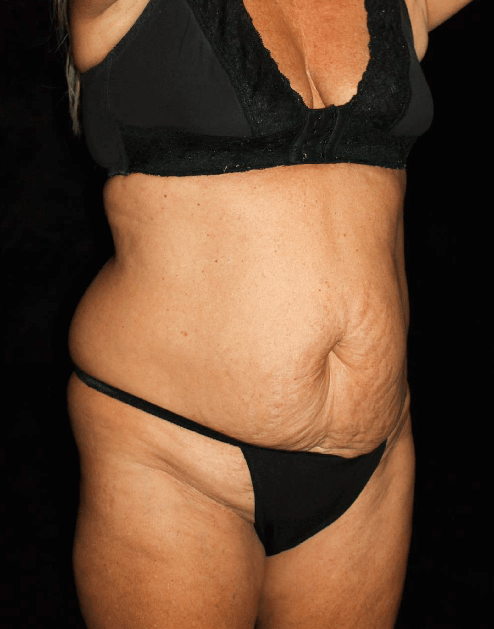 Liposuction Patient Photo - Case 15392 - before view-1