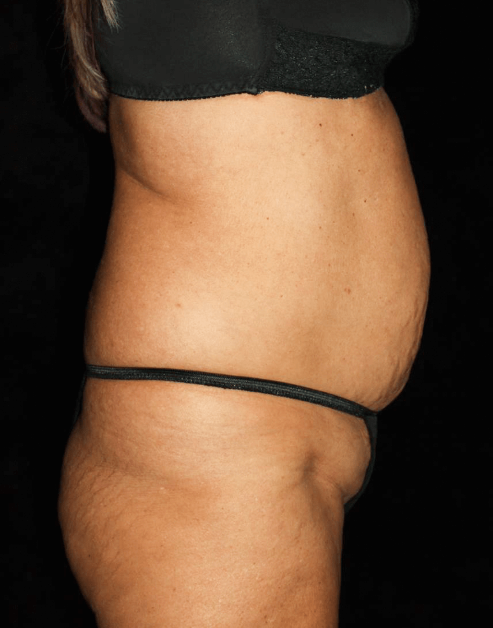 Liposuction Patient Photo - Case 15392 - before view-2