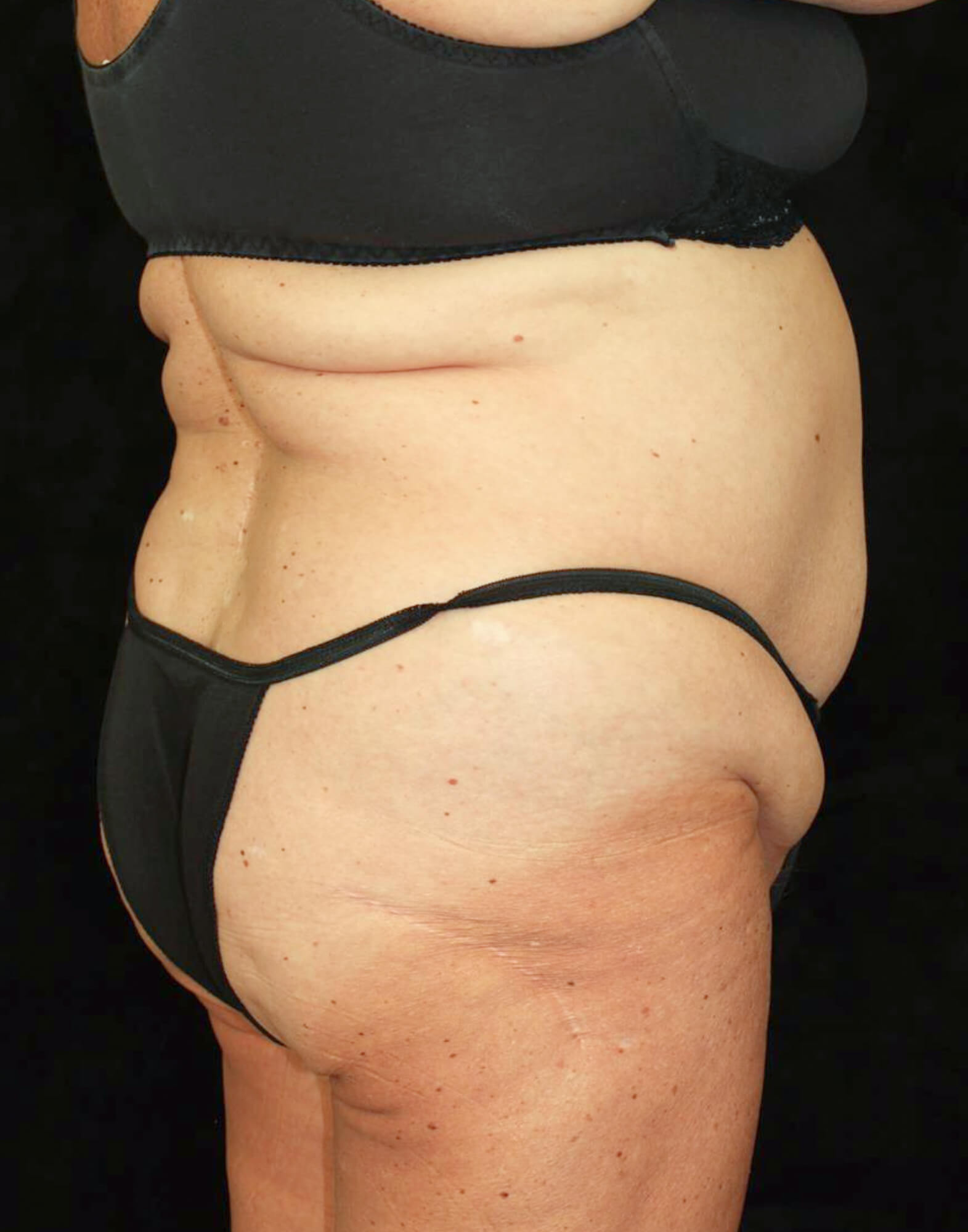Liposuction Patient Photo - Case 10761 - before view-3