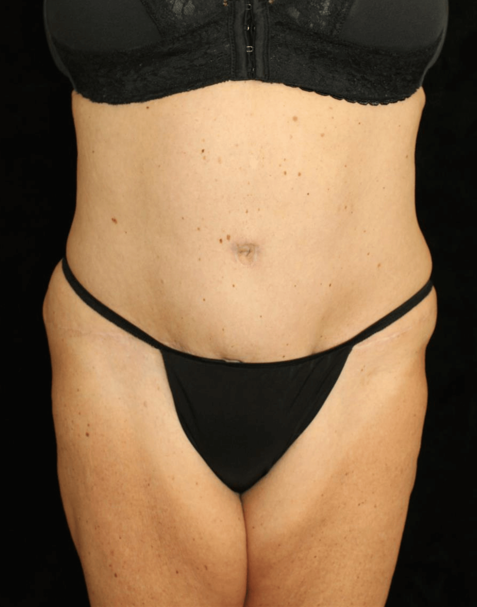 Liposuction Patient Photo - Case 10761 - after view