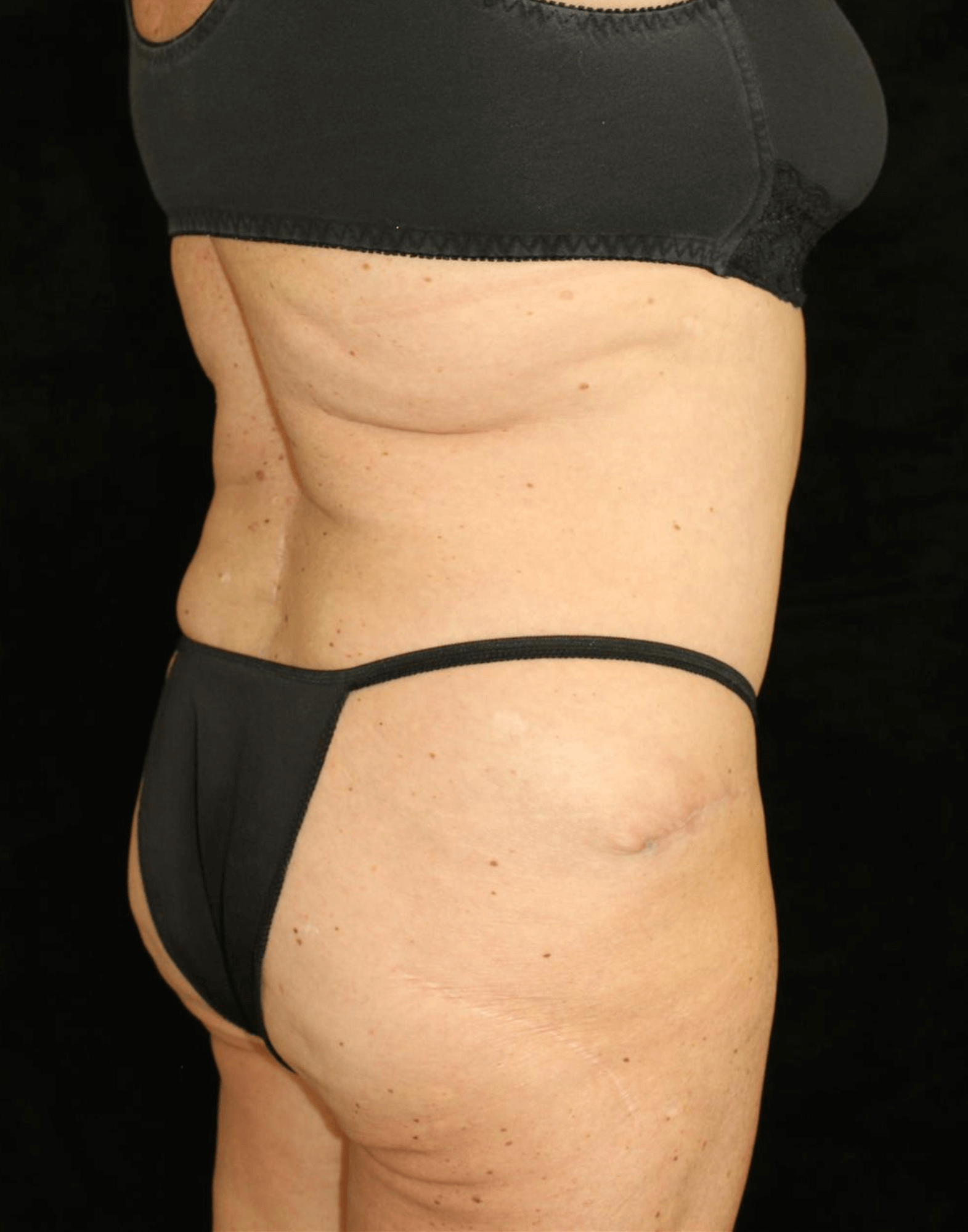 Liposuction Patient Photo - Case 10761 - after view-3
