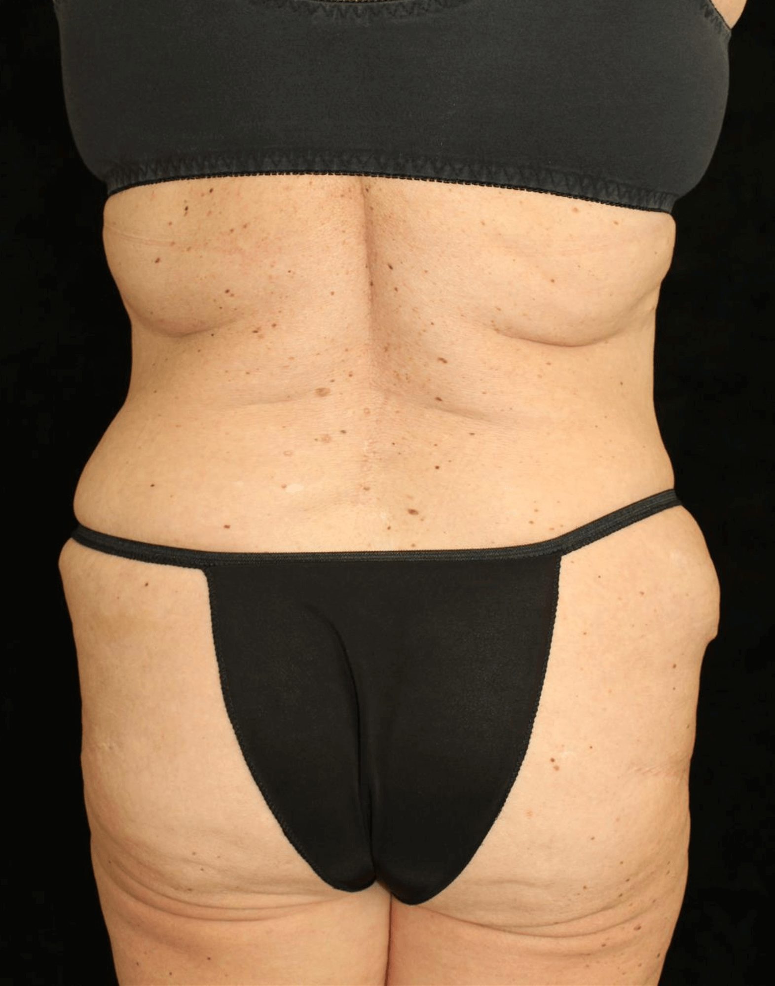 Liposuction Patient Photo - Case 10761 - after view-4