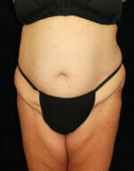 Liposuction before and after results - Nashville patient - Before