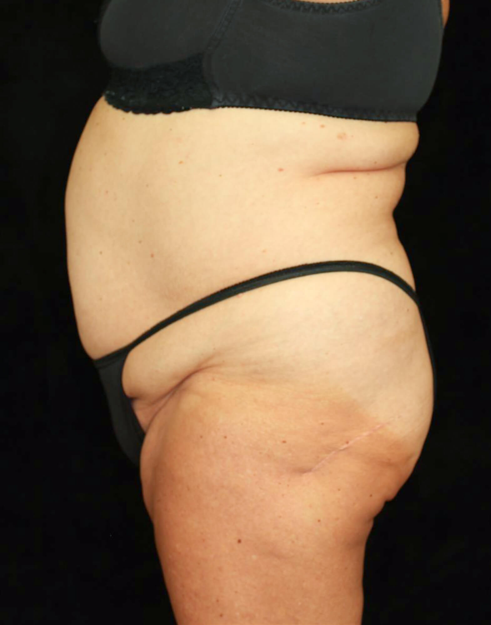 Liposuction Patient Photo - Case 10761 - before view-2