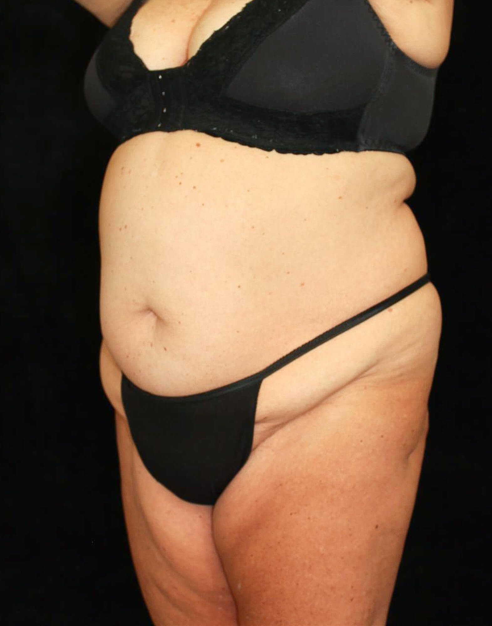 Liposuction Patient Photo - Case 10761 - before view-1