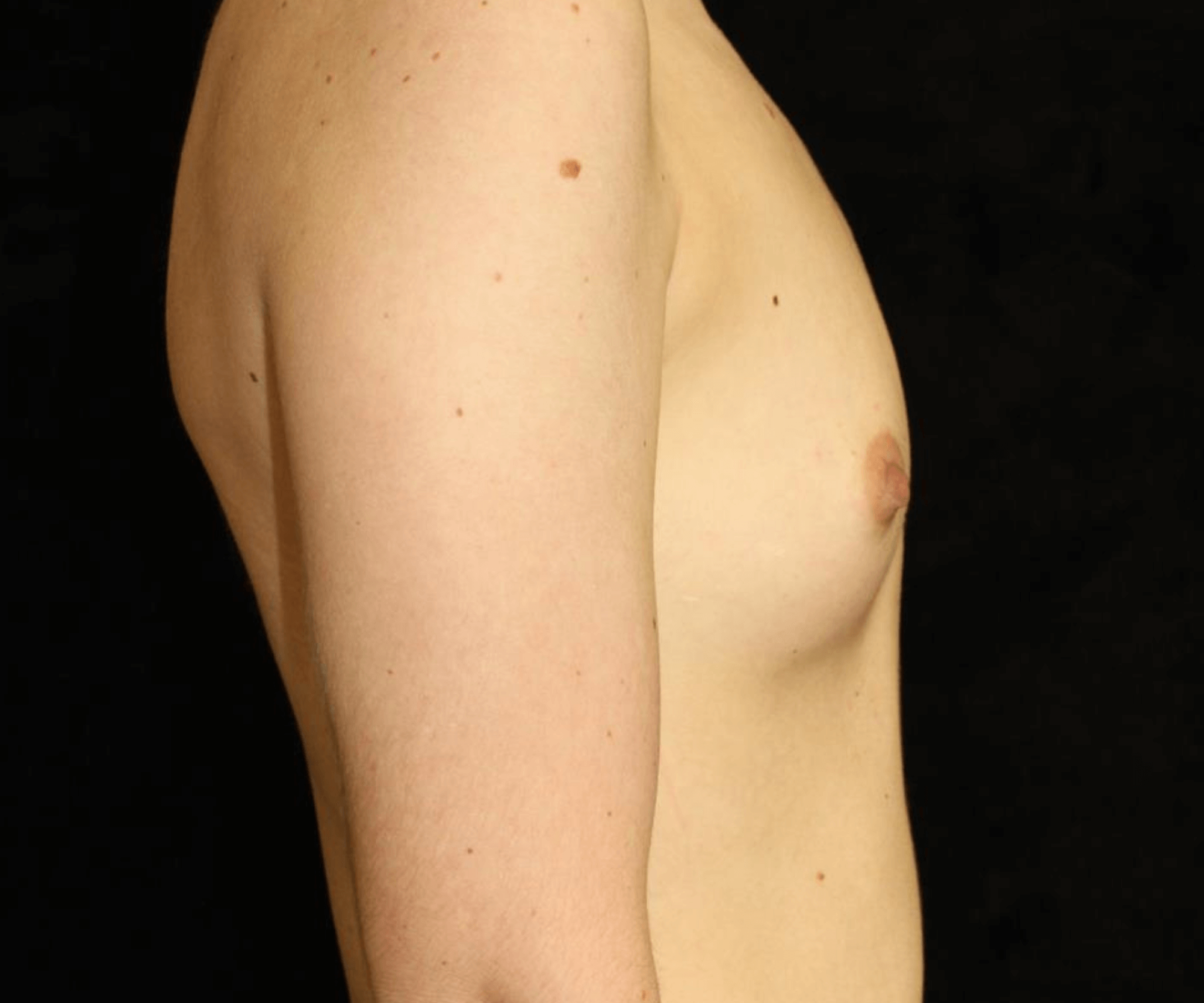 Breast Augmentation Patient Photo - Case 18326 - before view-2