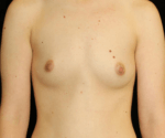 Breast Augmentation - Case 18326 - Before