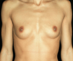Breast Augmentation - Case 17906 - Before