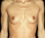 Breast Augmentation before and after results - Nashville patient - Before