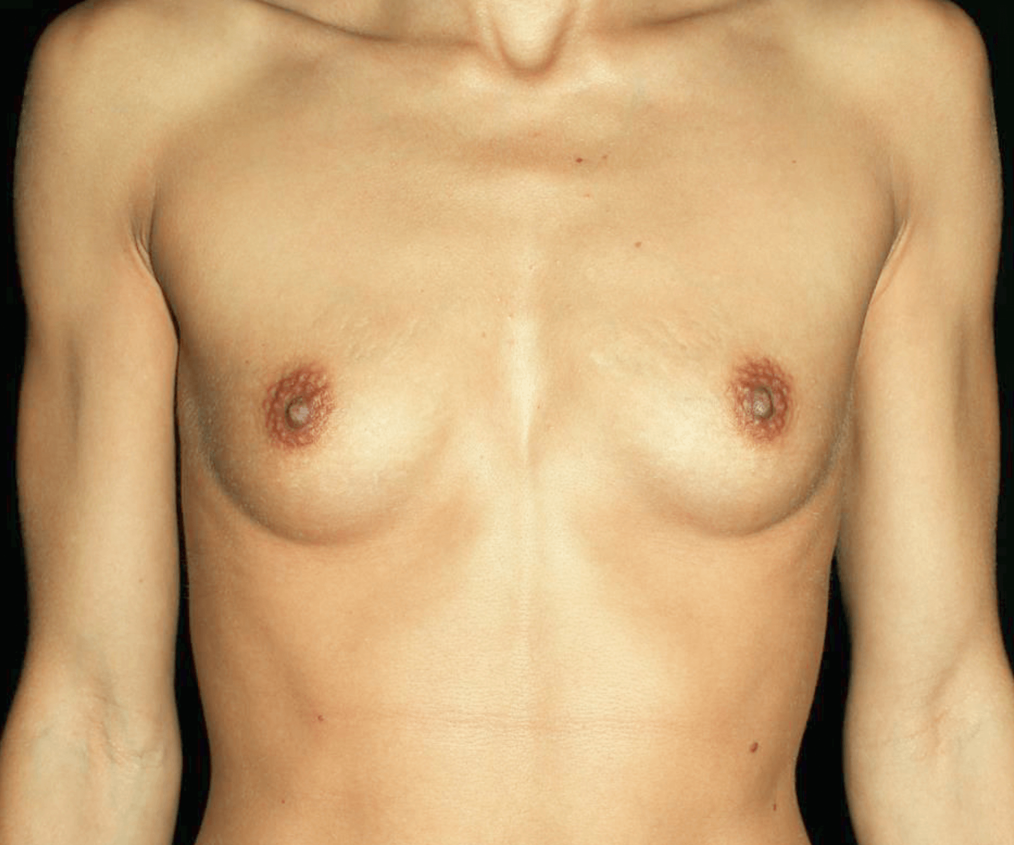 Breast Augmentation Patient Photo - Case 17906 - before view-