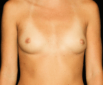 Breast Asymmetry - Case 16995 - Before
