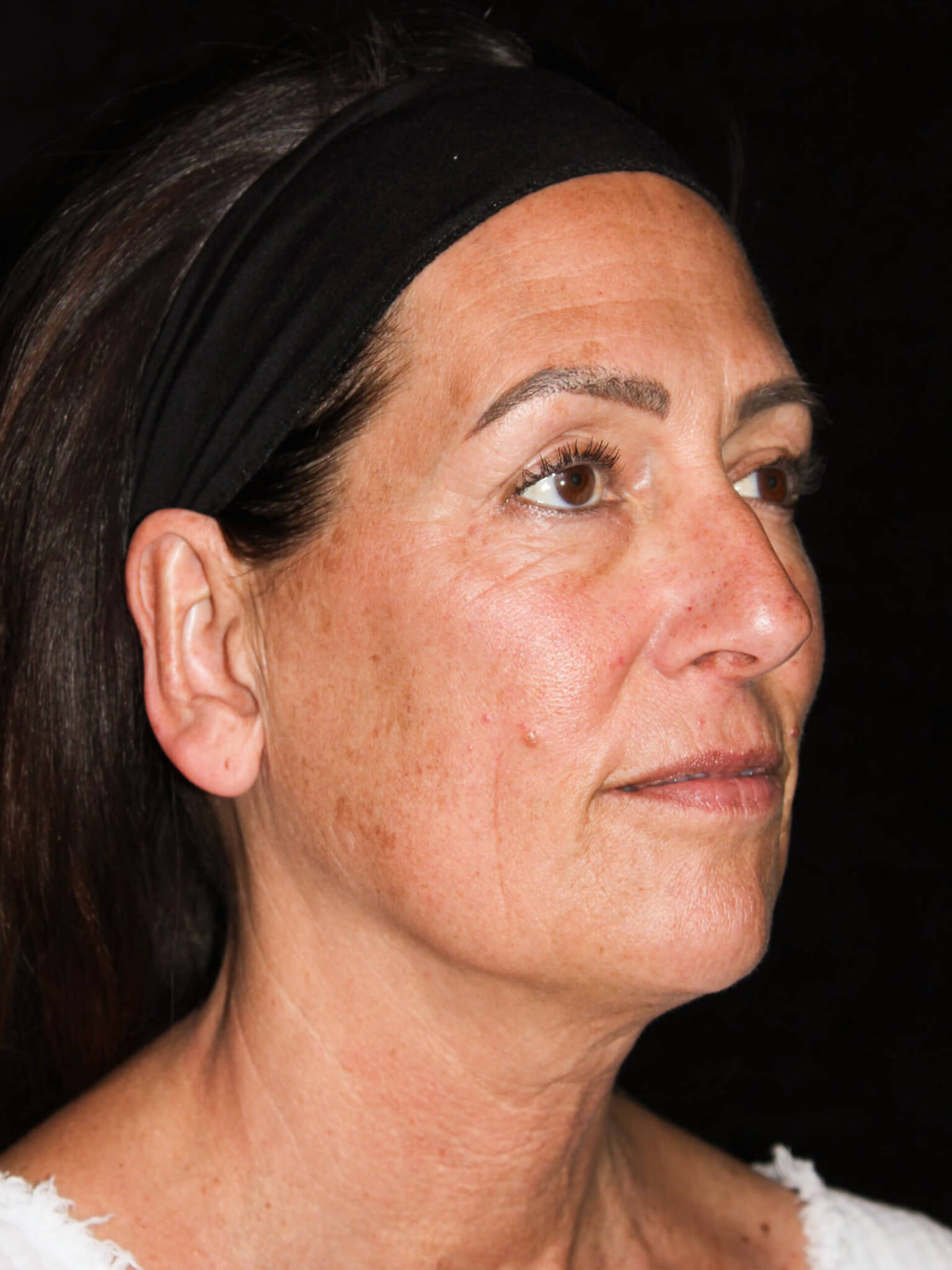 Facelift Patient Photo - Case 8940 - before view-1