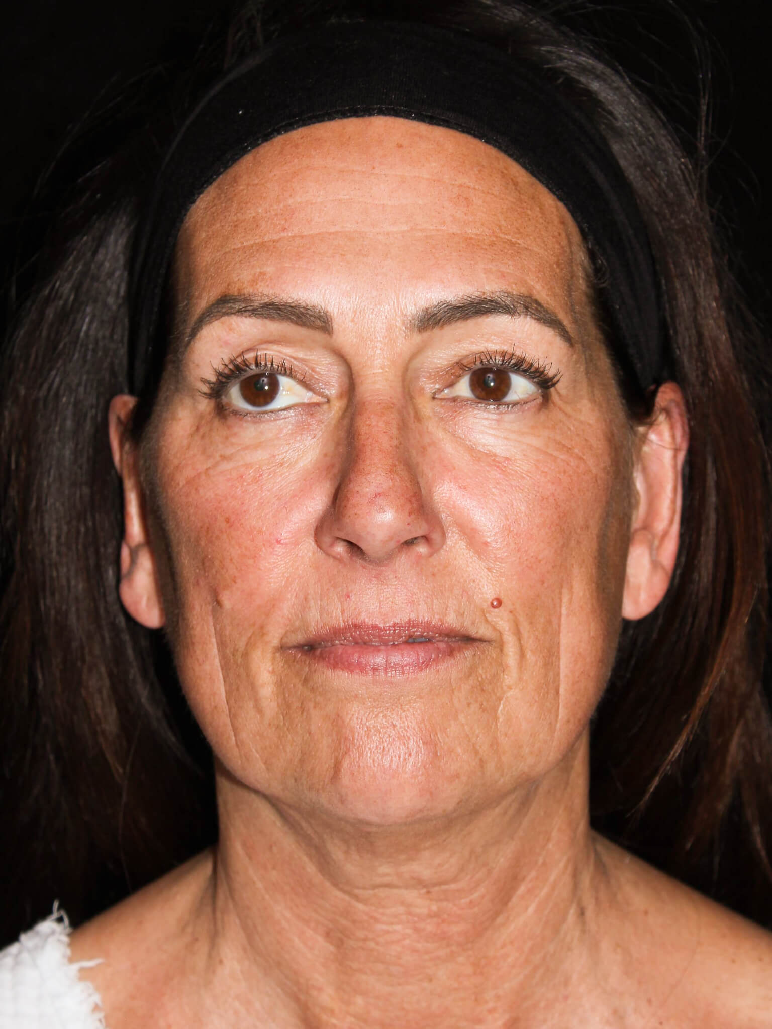 Facelift Patient Photo - Case 8940 - before view-