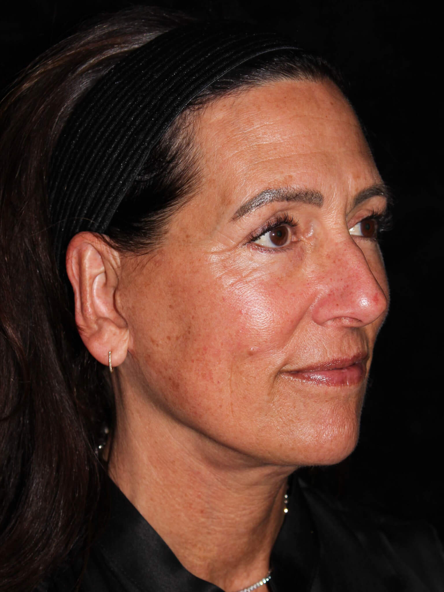 Facelift Patient Photo - Case 8940 - after view-1