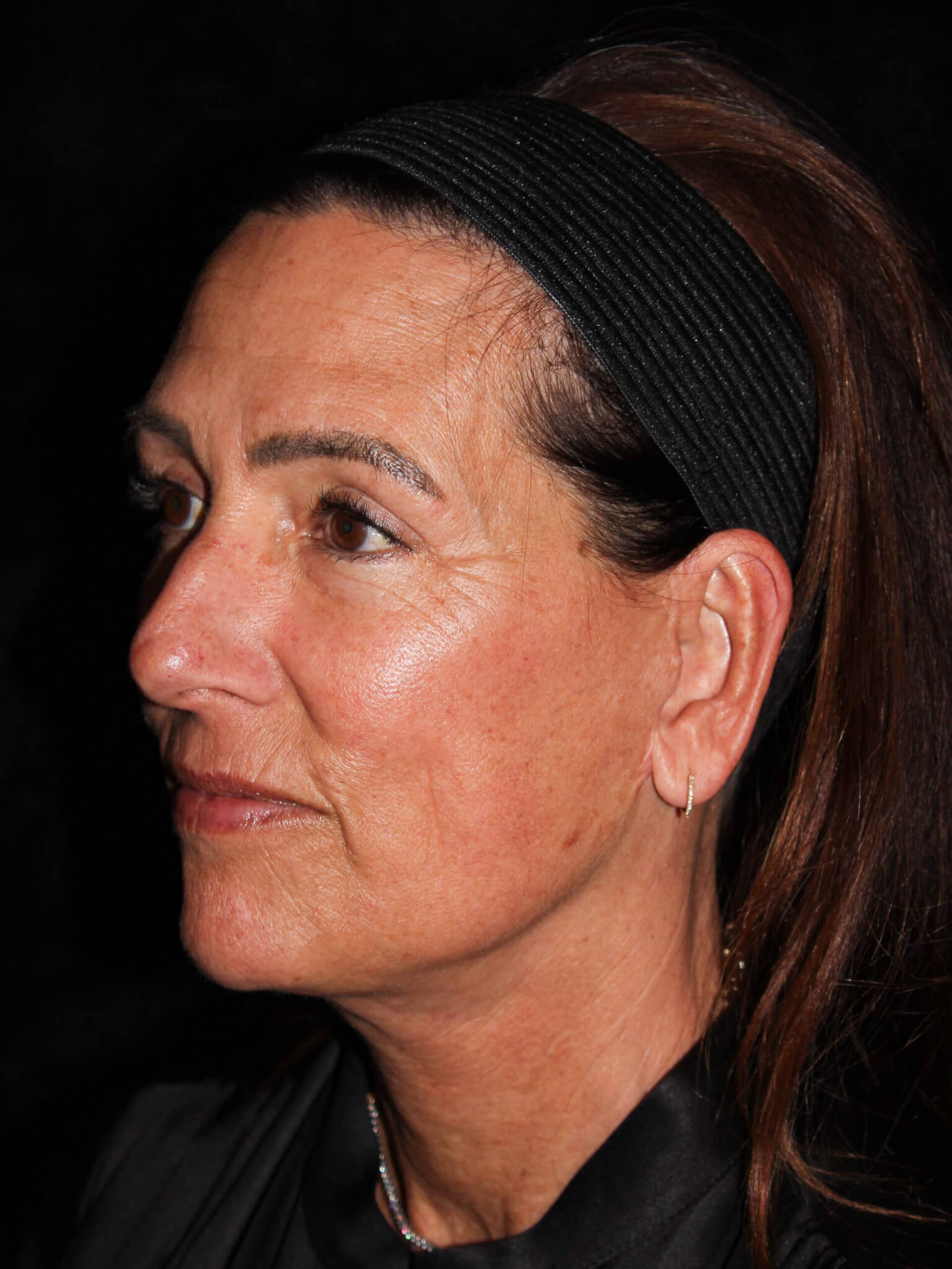 Facelift Patient Photo - Case 8940 - after view-2