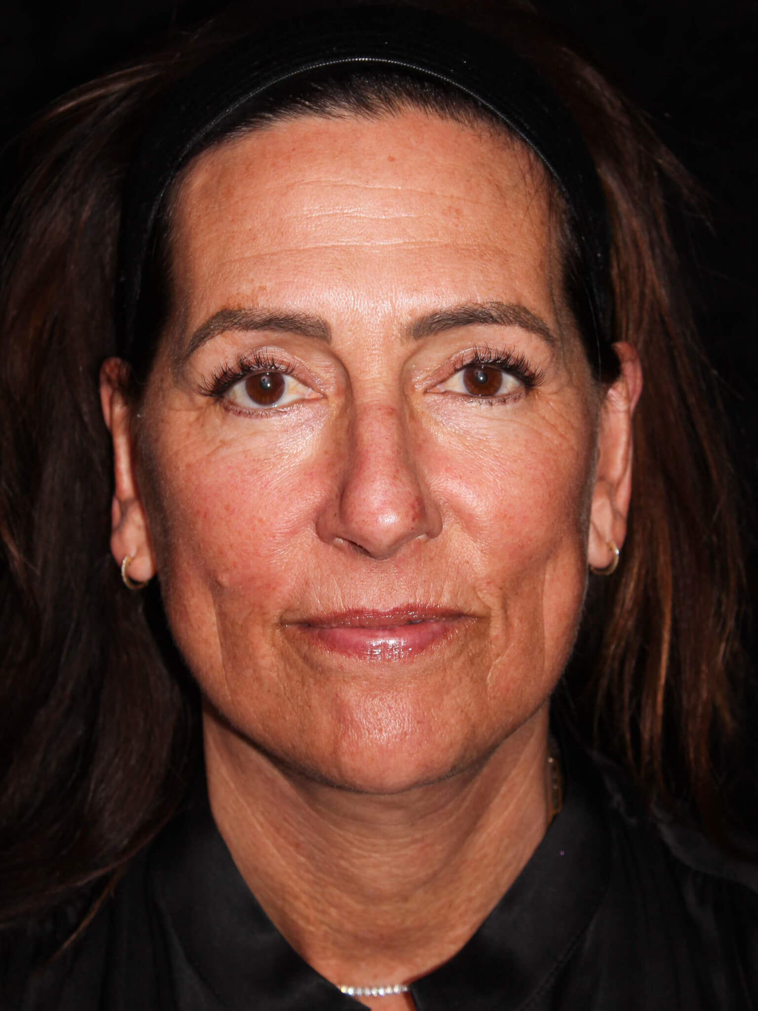 Facelift Patient Photo - Case 8940 - after view