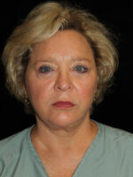 Laser Services before and after results - Nashville patient - After