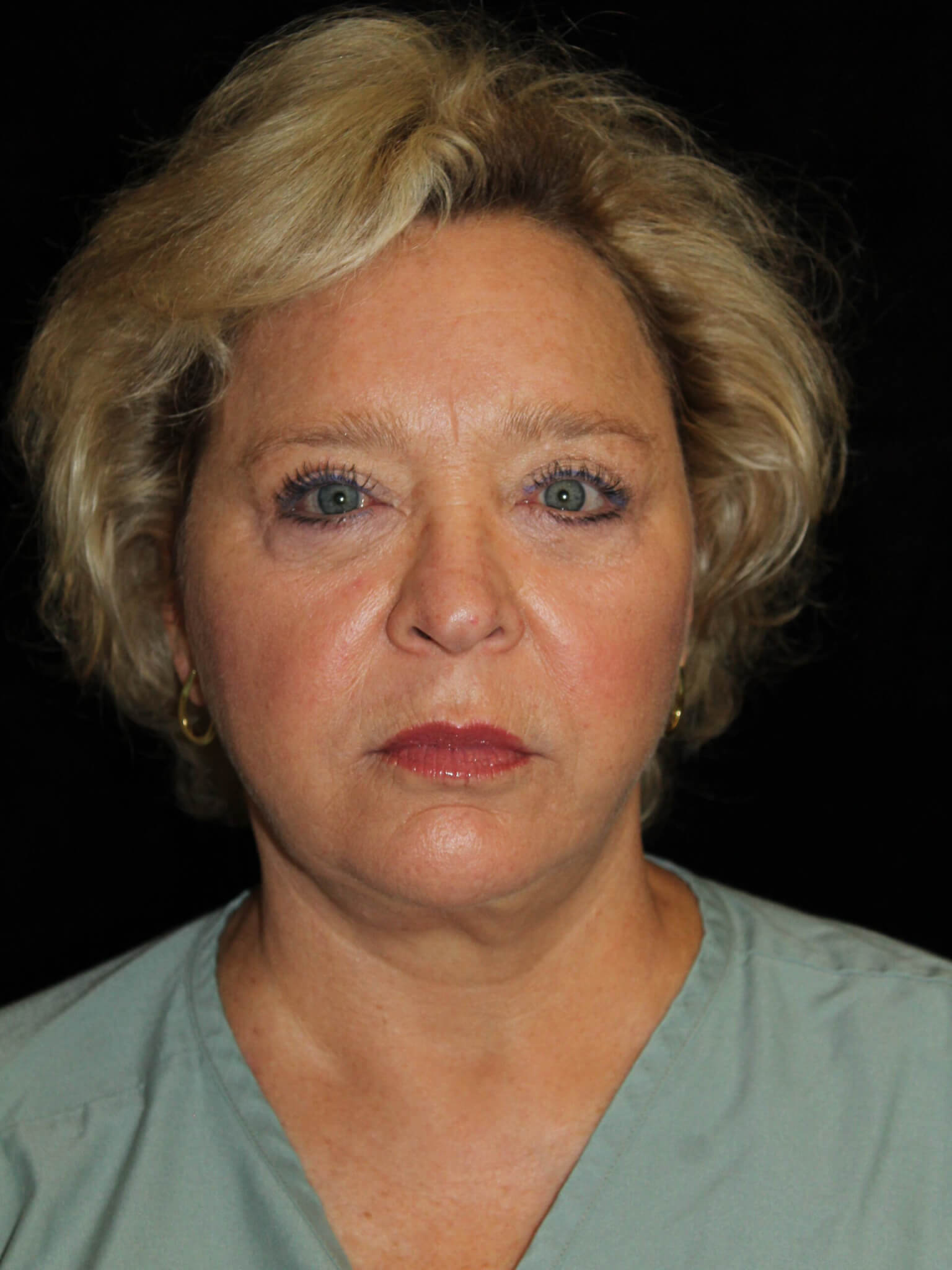 Laser Services Patient Photo - Case 10761 - after view