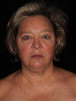 Laser Services before and after results - Nashville patient - Before