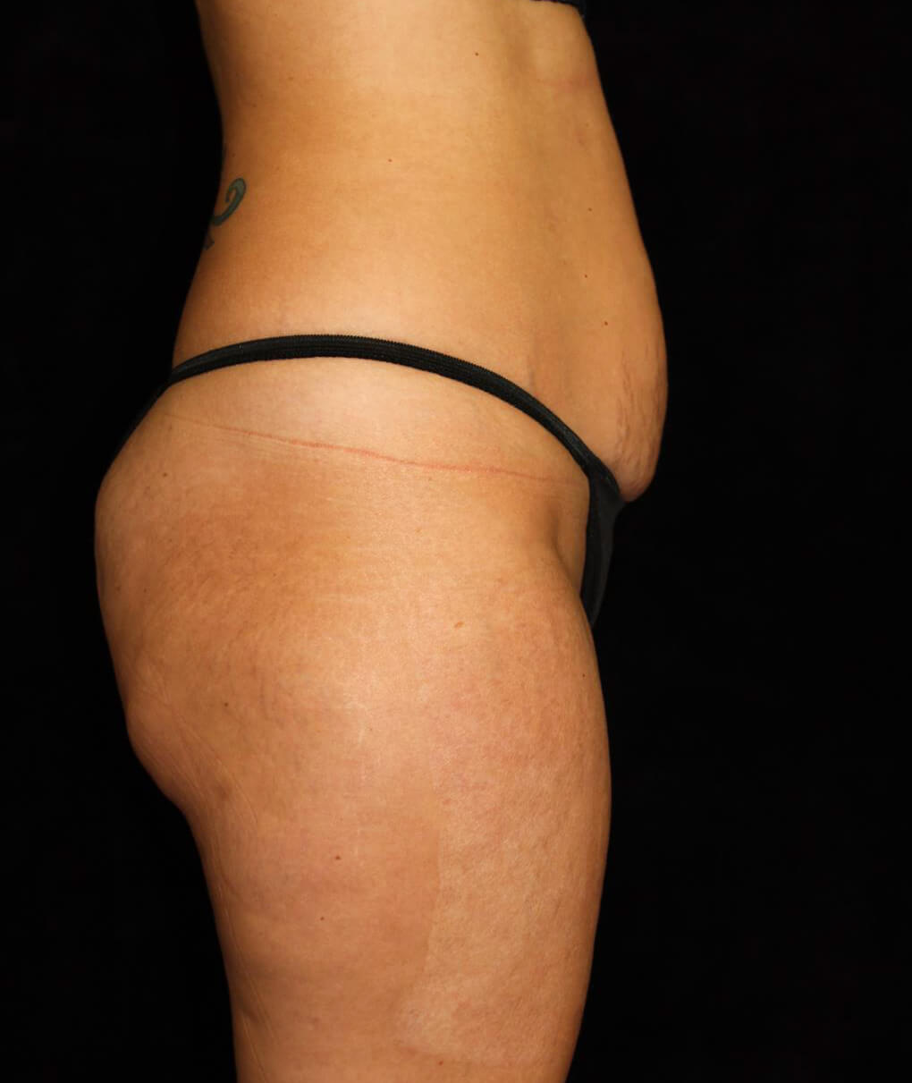 Liposuction Patient Photo - Case 13564 - before view-2