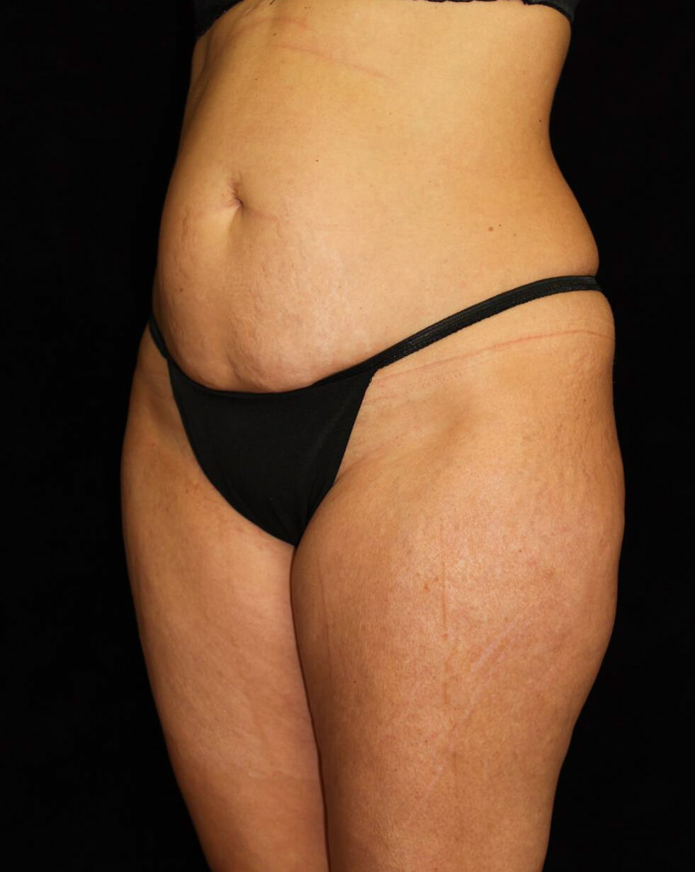 Liposuction Patient Photo - Case 13564 - before view-1