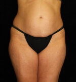 Liposuction - Case 13564 - Before