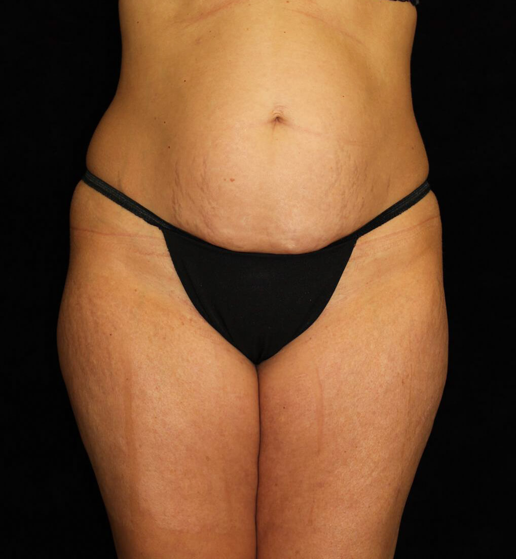 Liposuction Patient Photo - Case 13564 - before view-