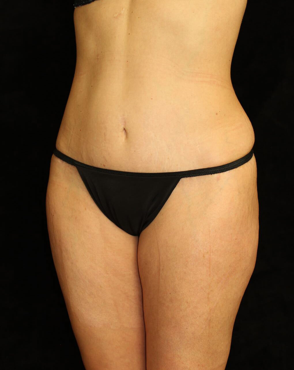 Liposuction Patient Photo - Case 13564 - after view-1