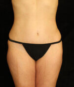 Liposuction - Case 13564 - After