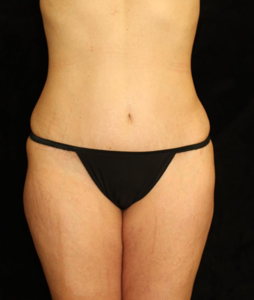 Liposuction Patient Photo - Case 13564 - after view