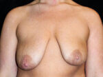 Breast Asymmetry - Case 16170 - Before