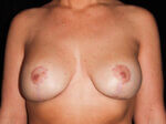 Breast Asymmetry - Case 16170 - After