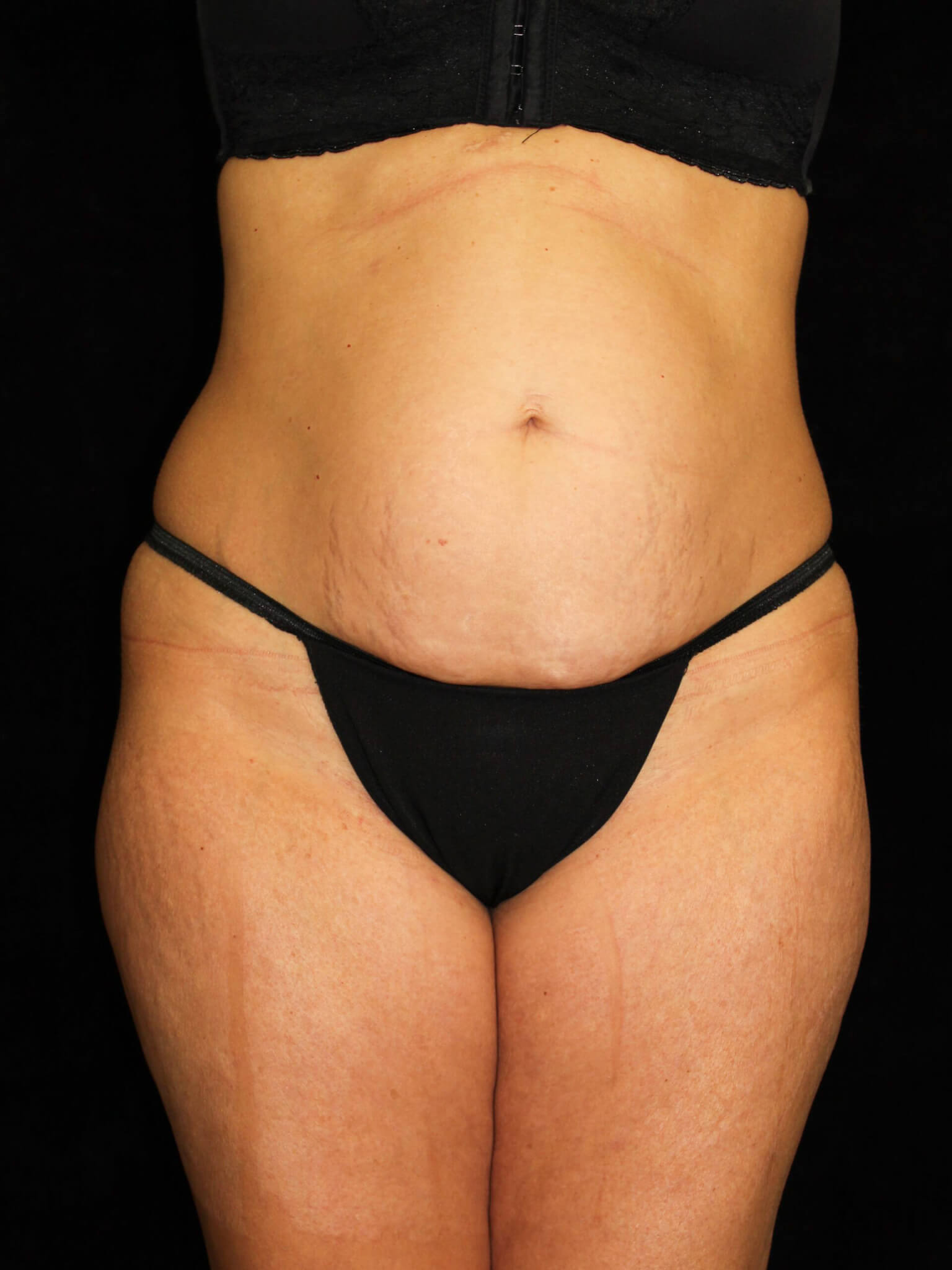Liposuction Patient Photo - Case 13564 - before view-