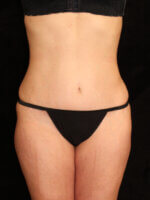 Liposuction before and after results - Nashville patient - After