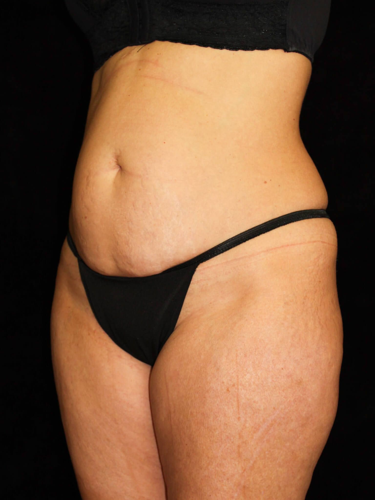 Liposuction Patient Photo - Case 13564 - before view-1