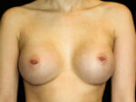 Breast Augmentation before and after results - Nashville patient - After