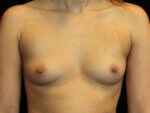 Breast Augmentation before and after results - Nashville patient - Before