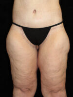 Thigh Lift - Case 14013 - After