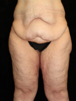 Thigh Lift - Case 14013 - Before