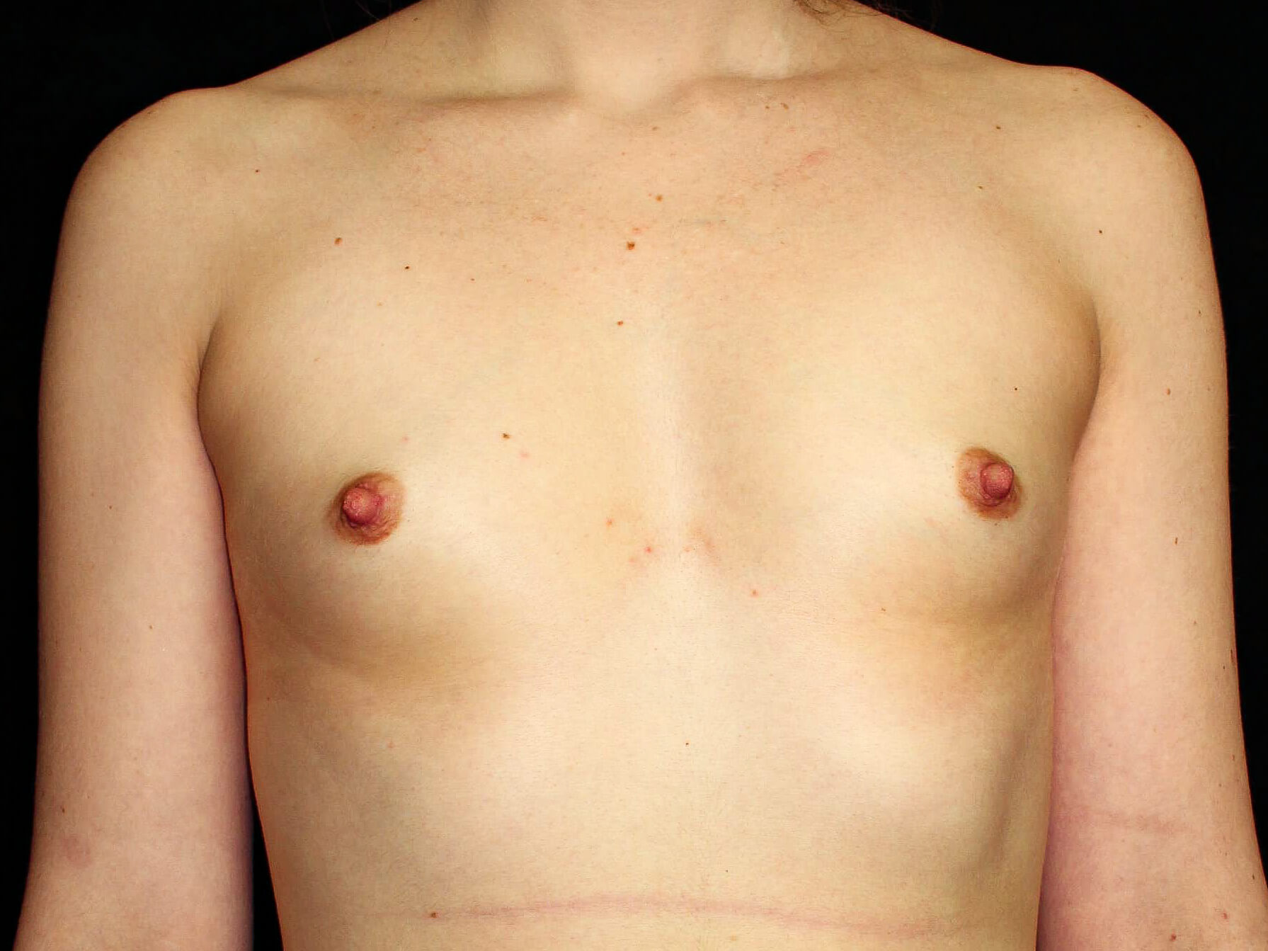 Breast Augmentation Patient Photo - Case 13640 - before view-