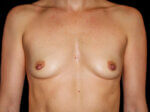 Breast Augmentation before and after results - Nashville patient - Before