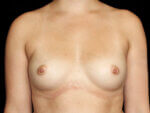 Breast Augmentation before and after results - Nashville patient - Before