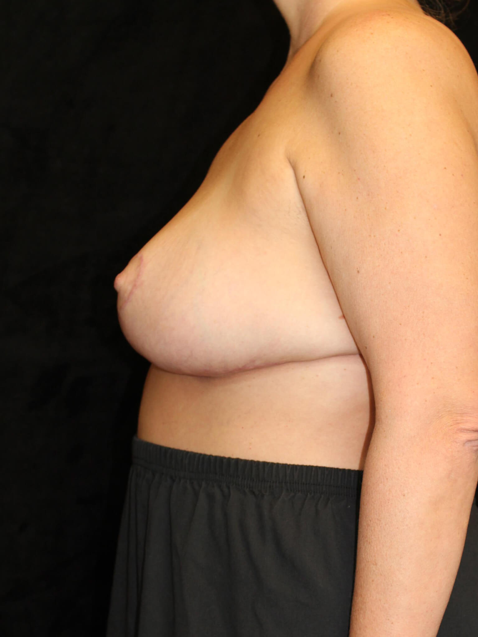 Breast Reduction Patient Photo - Case 15055 - after view-2