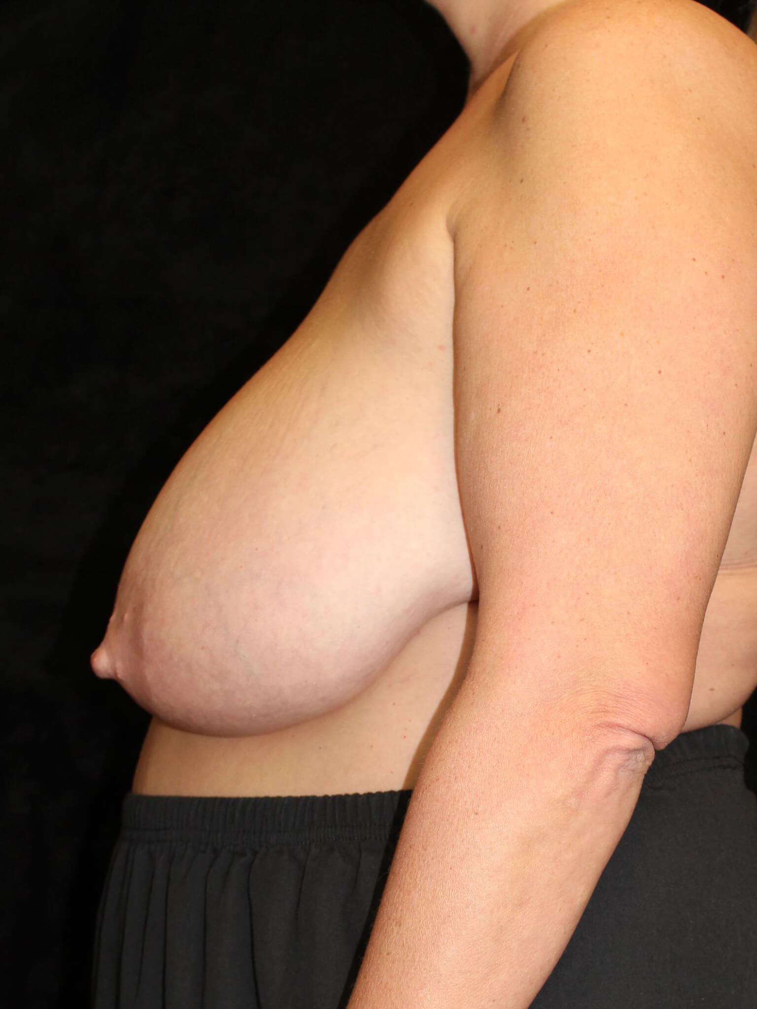 Breast Reduction Patient Photo - Case 15055 - before view-2