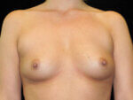 Breast Augmentation before and after results - Nashville patient - Before