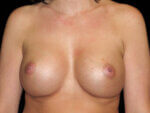 Breast Augmentation before and after results - Nashville patient - After