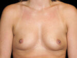 Breast Augmentation before and after results - Nashville patient - Before